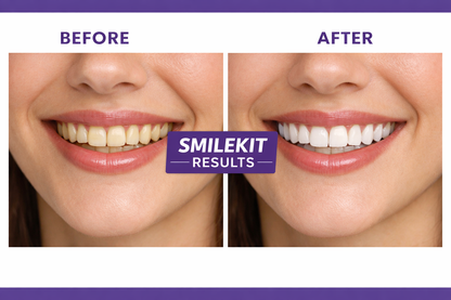 SmileKit UltraBright Whitening Strips